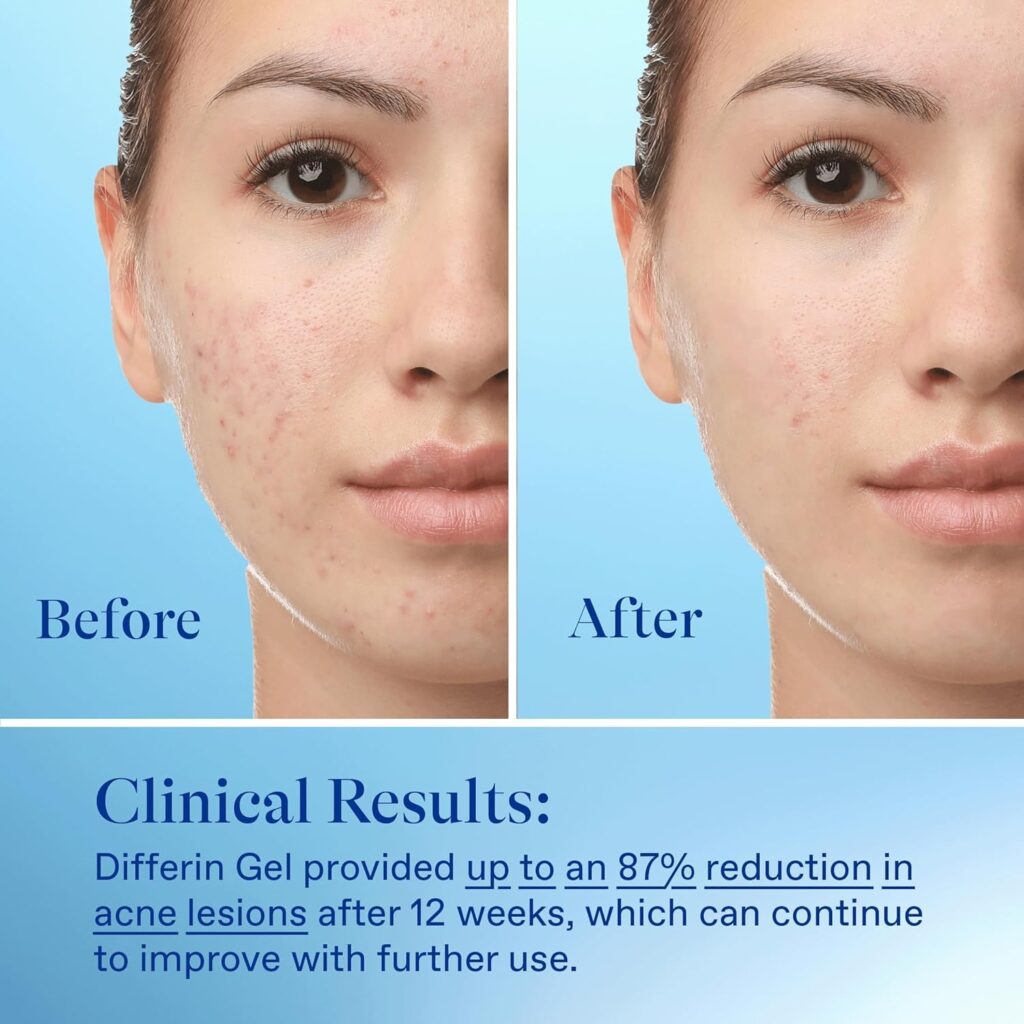 The 5 Best Products for Hormonal Acne in 2025: A Dermatologist-Approved Guide 10 Differin