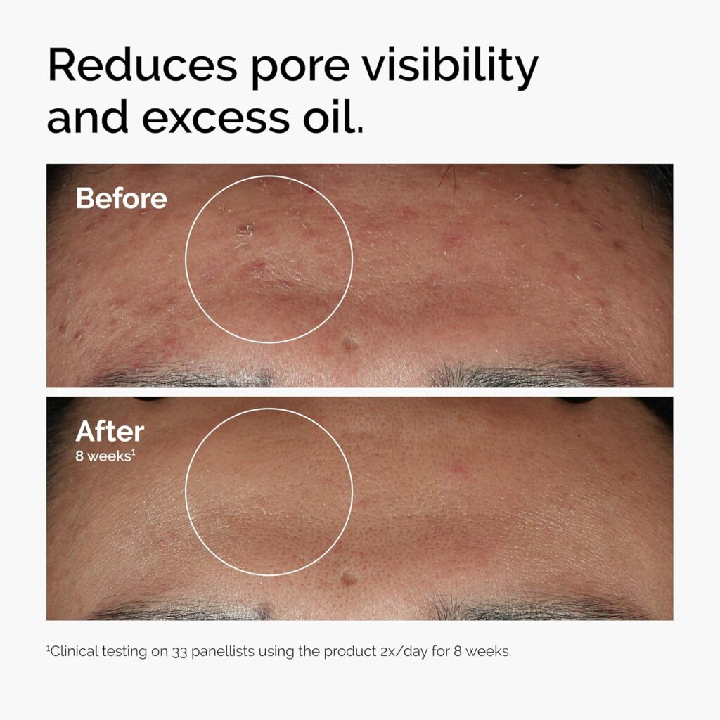 The 5 Best Products for Hormonal Acne in 2025: A Dermatologist-Approved Guide 8 Ordinary